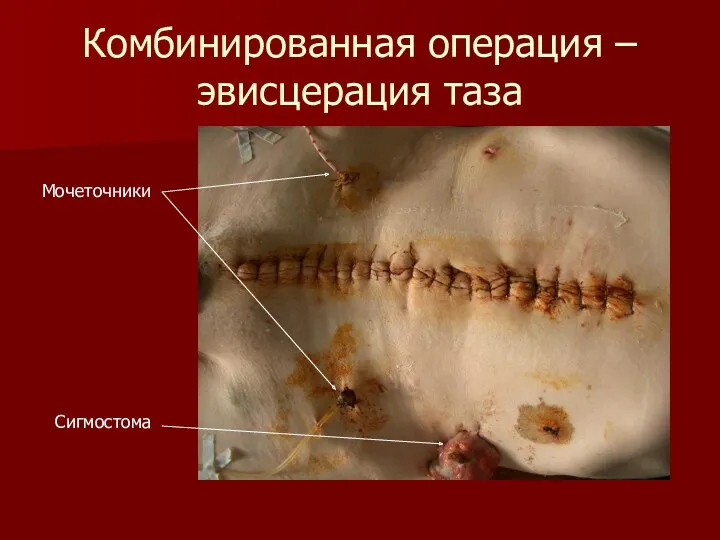 Комбинированная операция – эвисцерация таза Мочеточники Сигмостома