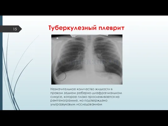 Туберкулезный плеврит Незначительное количество жидкости в правом заднем реберно-диафрагмальном синусе,