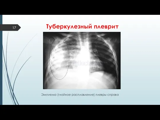 Туберкулезный плеврит Эмпиема (гнойное расплавление) плевры справа