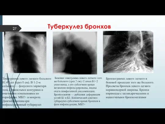 Туберкулез бронхов Бронхограмма левого легкого в боковой проекции того же