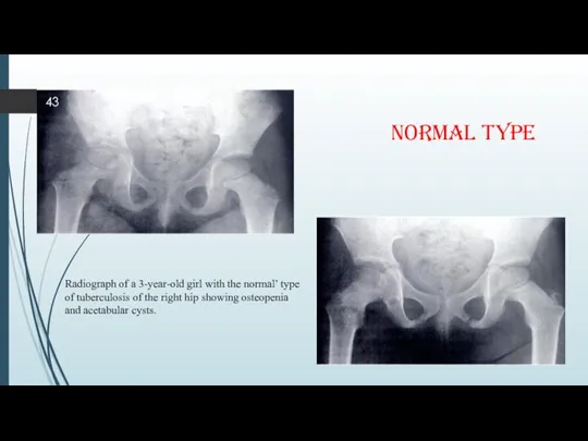 NORMAL TYPE Radiograph of a 3-year-old girl with the normal’