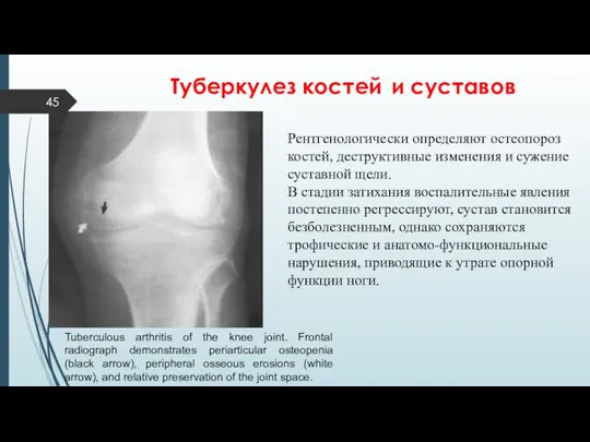 Туберкулез костей и суставов Рентгенологически определяют остеопороз костей, деструктивные изменения