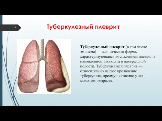 Туберкулезный плеврит Туберкулезный плеврит (в том числе эмпиема) — клиническая