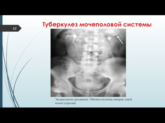 Туберкулез мочеполовой системы Экскреторная урограмма. Обызвествленная каверна левой почки (стрелка)