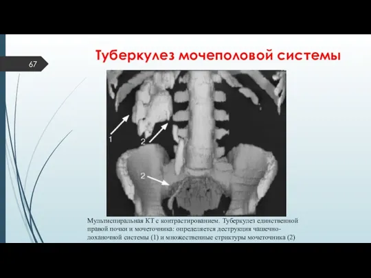 Туберкулез мочеполовой системы Мультиспиральная КТ с контрастированием. Туберкулез единственной правой