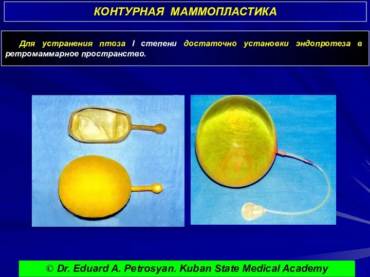 КОНТУРНАЯ МАММОПЛАСТИКА © Dr. Eduard A. Petrosyan. Kuban State Medical Academy Для устранения