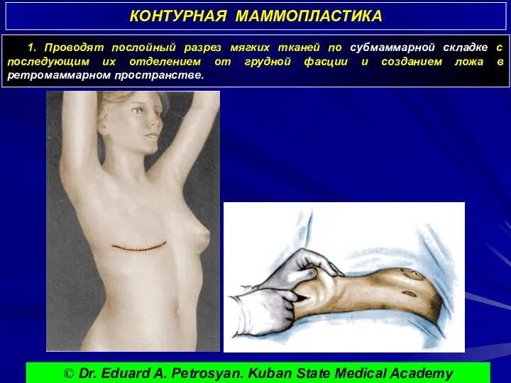 КОНТУРНАЯ МАММОПЛАСТИКА © Dr. Eduard A. Petrosyan. Kuban State Medical Academy 1. Проводят