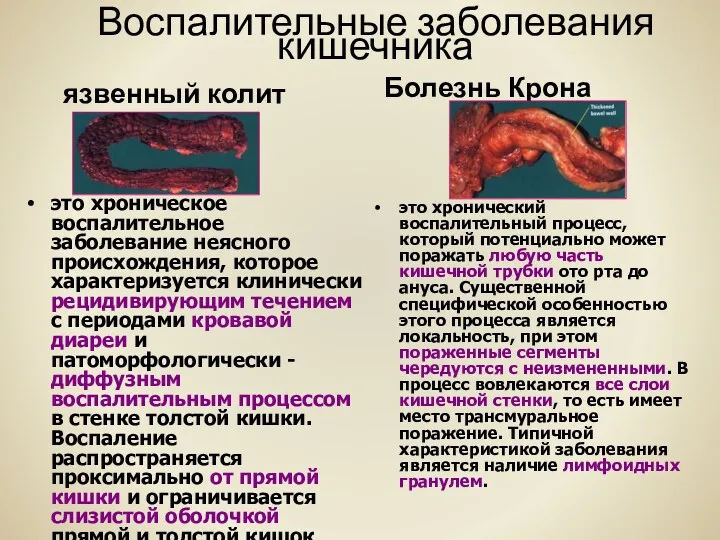 Воспалительные заболевания кишечника язвенный колит это хроническое воспалительное заболевание неясного