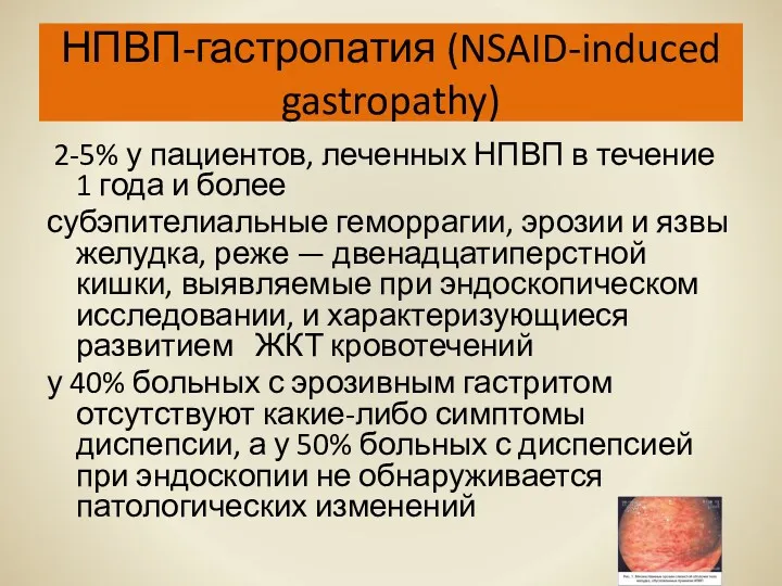НПВП-гастропатия (NSAID-induced gastropathy) 2-5% у пациентов, леченных НПВП в течение