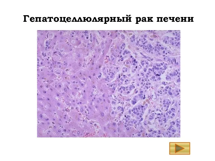 Гепатоцеллюлярный рак печени