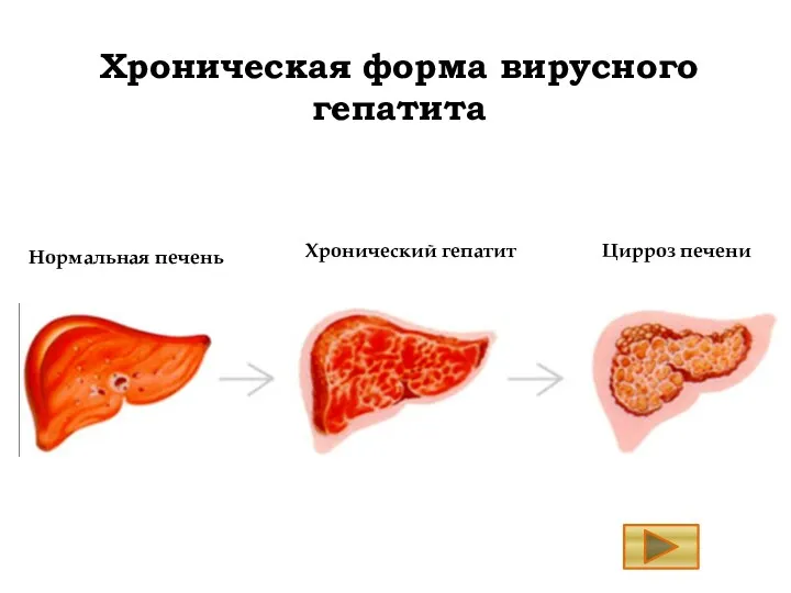 Хроническая форма вирусного гепатита Нормальная печень Хронический гепатит Цирроз печени