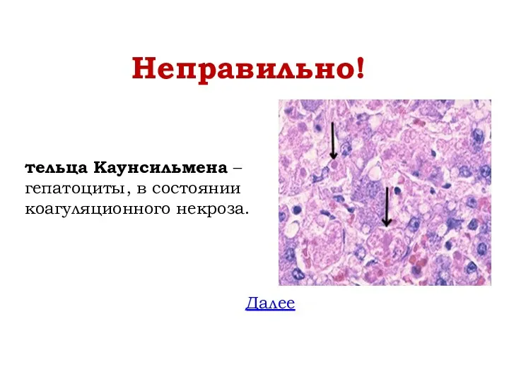 Неправильно! тельца Каунсильмена – гепатоциты, в состоянии коагуляционного некроза. Далее