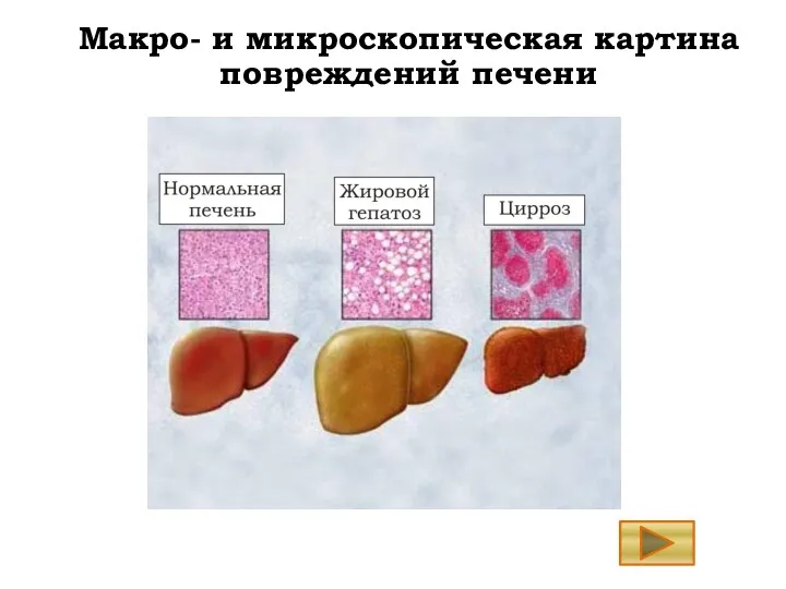 Макро- и микроскопическая картина повреждений печени