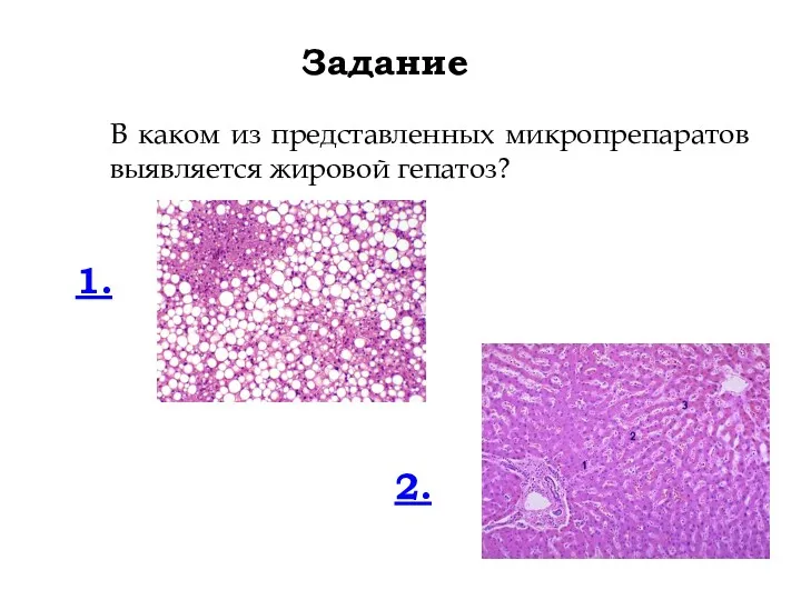 Задание В каком из представленных микропрепаратов выявляется жировой гепатоз? 1. 2.