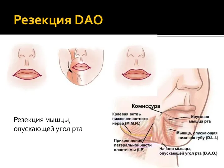 Резекция DAO Резекция мышцы, опускающей угол рта
