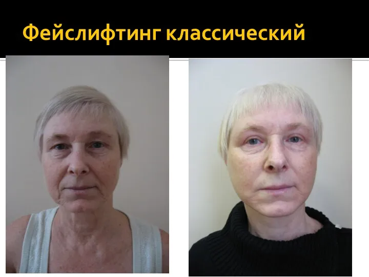 Фейслифтинг классический