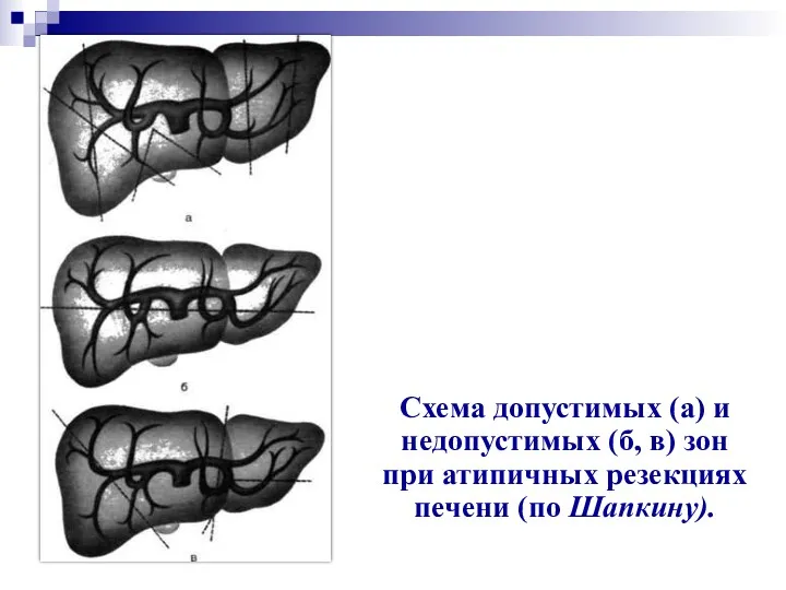 Схема допустимых (а) и недопустимых (б, в) зон при атипичных резекциях печени (по Шапкину).