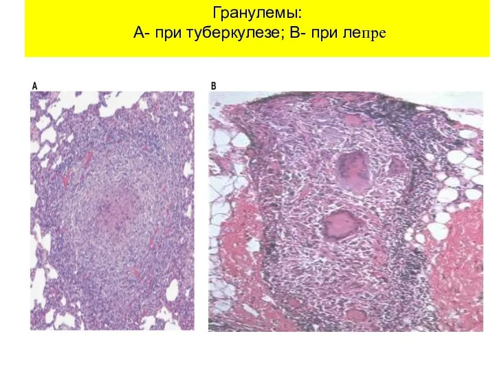 Гранулемы: А- при туберкулезе; В- при лепре