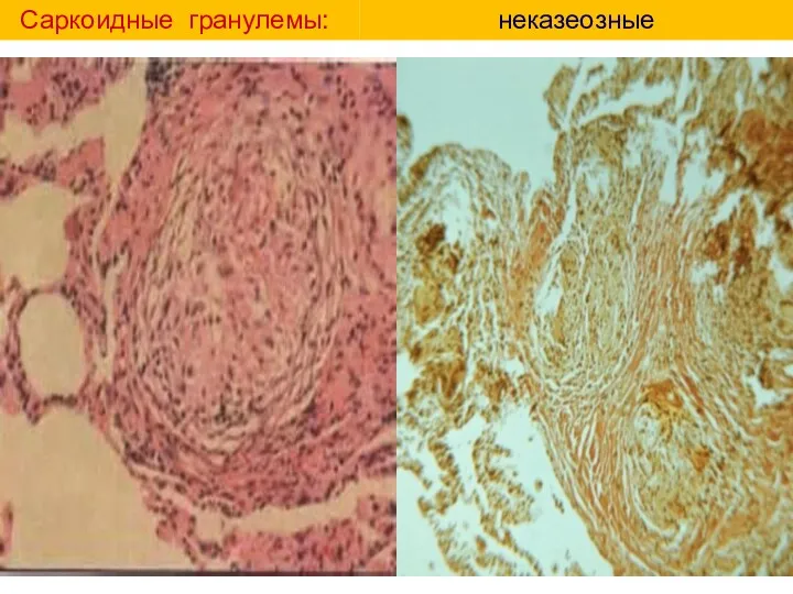 Саркоидные гранулемы: неказеозные