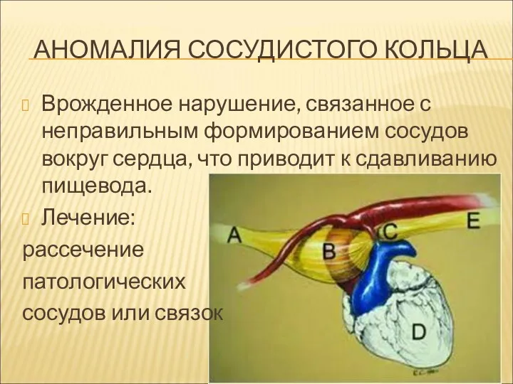 АНОМАЛИЯ СОСУДИСТОГО КОЛЬЦА Врожденное нарушение, связанное с неправильным формированием сосудов