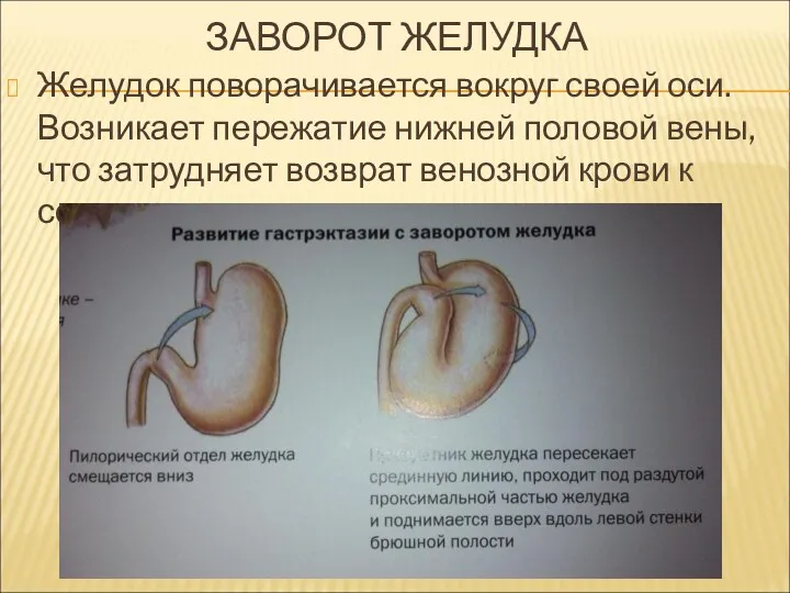 ЗАВОРОТ ЖЕЛУДКА Желудок поворачивается вокруг своей оси. Возникает пережатие нижней