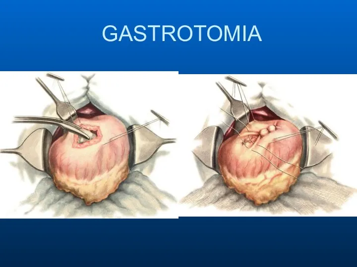 GASTROTOMIA