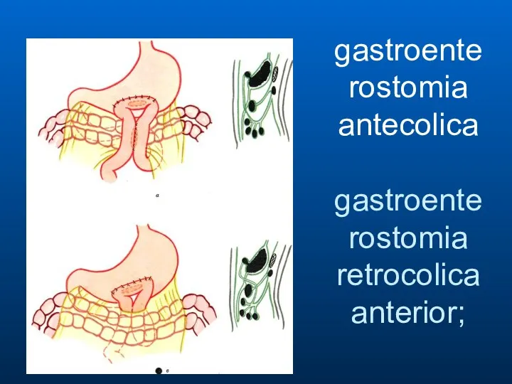 gastroenterostomia antecolica gastroenterostomia retrocolica anterior;