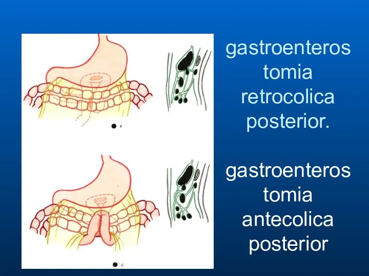 gastroenterostomia retrocolica posterior. gastroenterostomia antecolica posterior