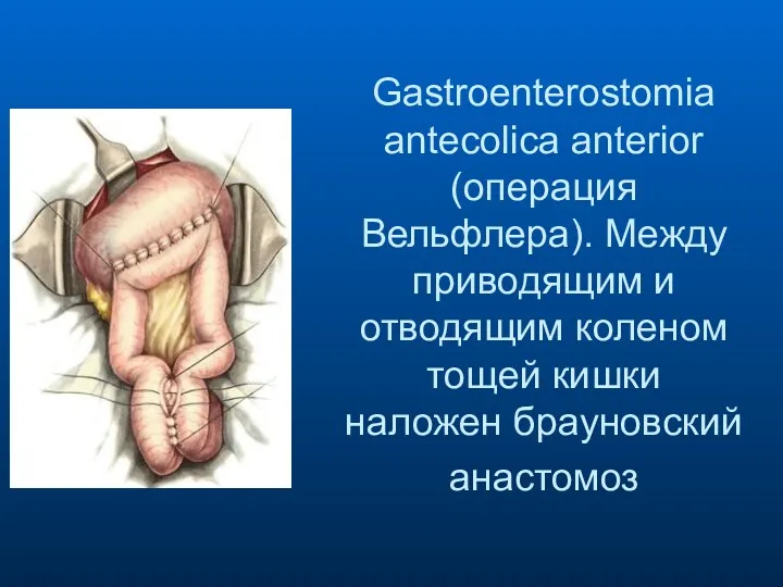 Gastroenterostomia antecolica anterior (операция Вельфлера). Между приводящим и отводящим коленом тощей кишки наложен брауновский анастомоз