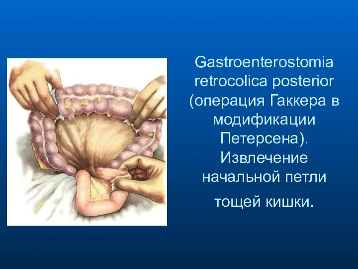 Gastroenterostomia retrocolica posterior (операция Гаккера в модификации Петерсена). Извлечение начальной петли тощей кишки.