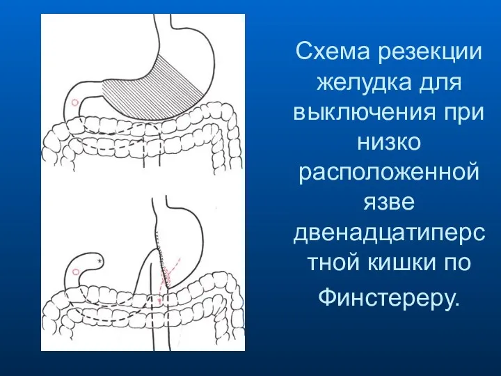 Схема резекции желудка для выключения при низко расположенной язве двенадцатиперстной кишки по Финстереру.