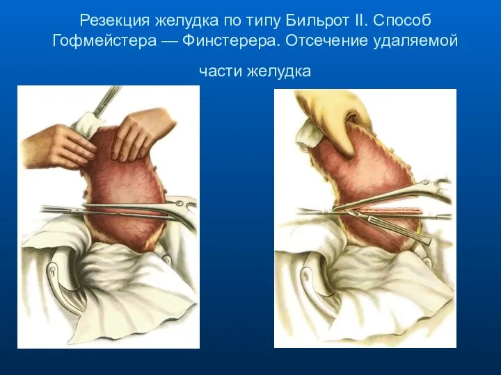 Резекция желудка по типу Бильрот II. Способ Гофмейстера — Финстерера. Отсечение удаляемой части желудка