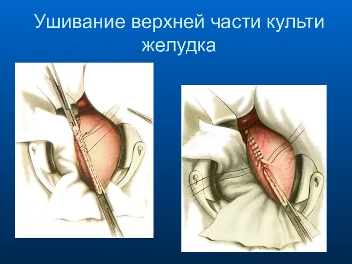 Ушивание верхней части культи желудка