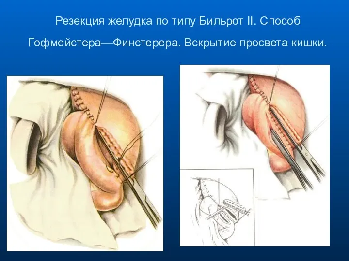 Резекция желудка по типу Бильрот II. Способ Гофмейстера—Финстерера. Вскрытие просвета кишки.