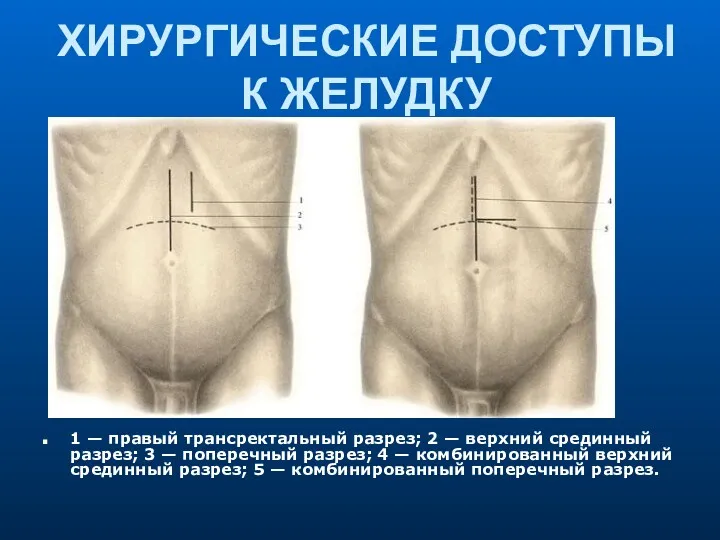 ХИРУРГИЧЕСКИЕ ДОСТУПЫ К ЖЕЛУДКУ 1 — правый трансректальный разрез; 2