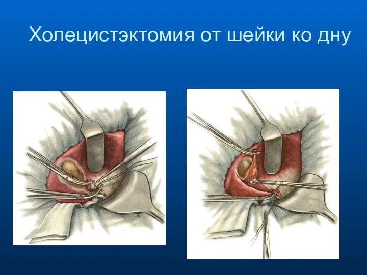 Холецистэктомия от шейки ко дну