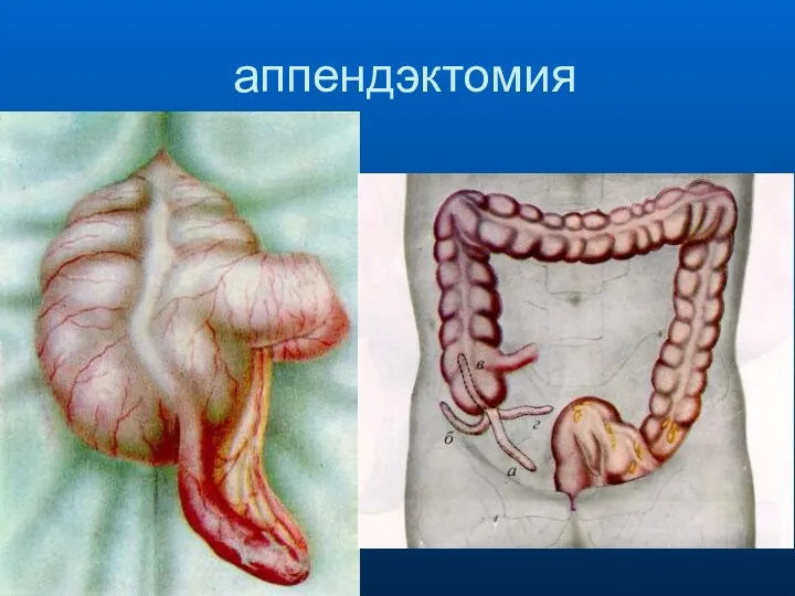 аппендэктомия