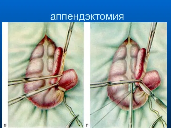 аппендэктомия