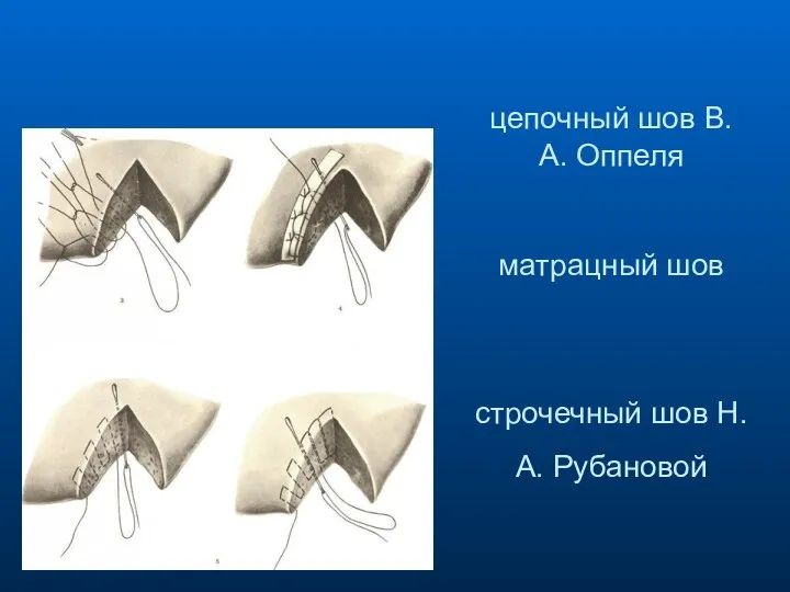 цепочный шов В. А. Оппеля матрацный шов строчечный шов Н. А. Рубановой