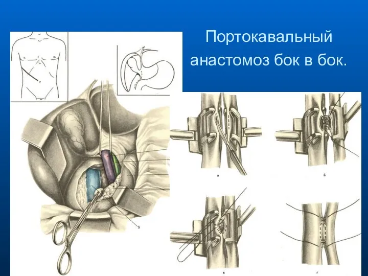 Портокавальный анастомоз бок в бок.