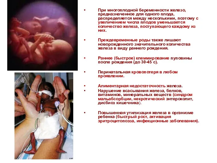 При многоплодной беременности железо, предназначенное для одного плода, распределяется между