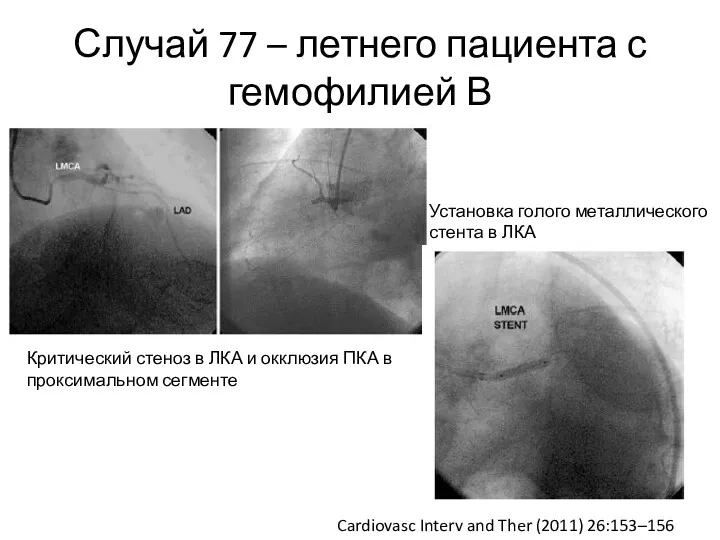 Случай 77 – летнего пациента с гемофилией В Cardiovasc Interv and Ther (2011)