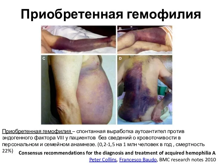 Приобретенная гемофилия Consensus recommendations for the diagnosis and treatment of acquired hemophilia A