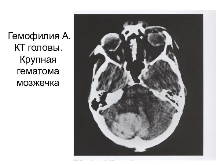 Гемофилия А. КТ головы. Крупная гематома мозжечка