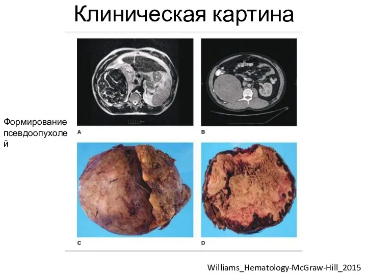 Клиническая картина Williams_Hematology-McGraw-Hill_2015 Формирование псевдоопухолей