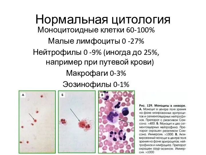 Нормальная цитология Моноцитоидные клетки 60-100% Малые лимфоциты 0 -27% Нейтрофилы