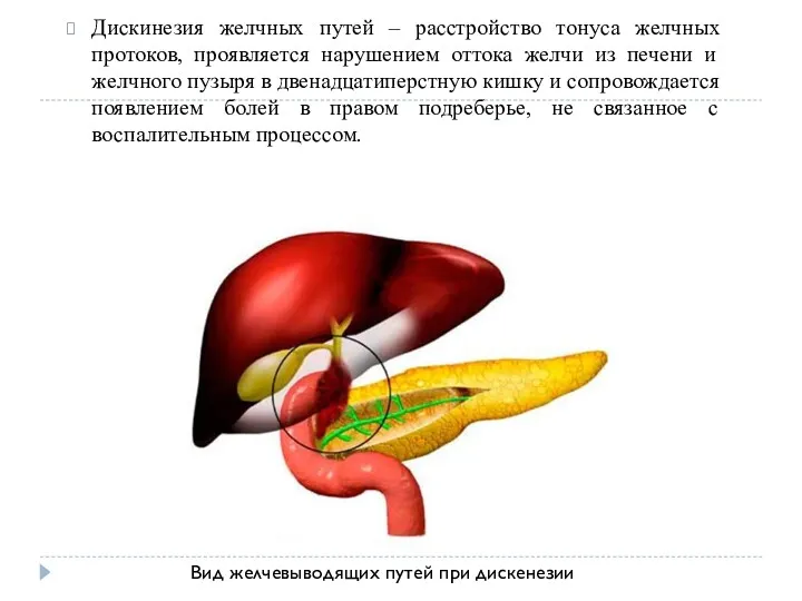 Дискинезия желчных путей – расстройство тонуса желчных протоков, проявляется нарушением оттока желчи из
