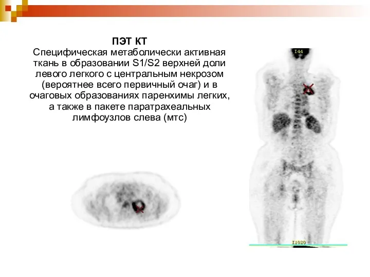 ПЭТ КТ Специфическая метаболически активная ткань в образовании S1/S2 верхней