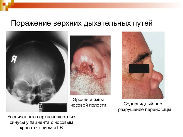 Поражение верхних дыхательных путей Эрозии и язвы носовой полости Седловидный