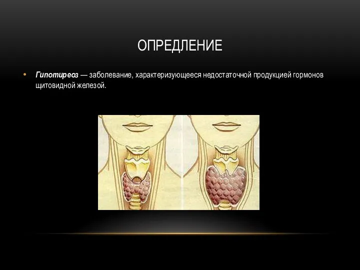 ОПРЕДЛЕНИЕ Гипотиреоз — заболевание, характеризующееся недостаточной продукцией гормонов щитовидной железой.